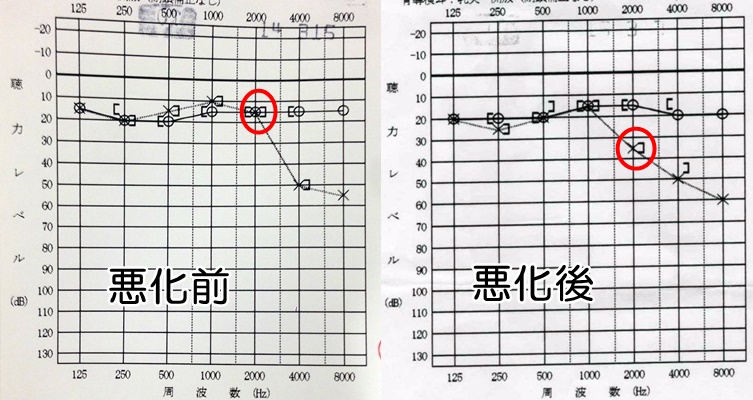 突発性難聴の悪化